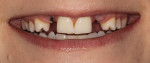 Fig 10. Implants were placed to replace missing upper lateral incisors. Cosmetic-prosthetic management was clearly a concern with the patient’s smile (surgical management by oral surgeon Leslie A. David, DDS).
