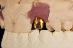 Fig 17. CAD/CAM abutment (Fig 17) and crown (Fig 18) designed to support molded tissue, No 10.