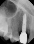Fig 22. Final radiographs showing excellent
transition and fit among implant, abutment, and crown (implant placement by Leslie A.
David, DDS).