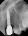 Fig 23. Final radiographs showing excellent
transition and fit among implant, abutment, and crown (implant placement by Leslie A.
David, DDS).