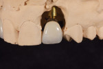 Fig 18. CAD/CAM abutment (Fig 17) and crown (Fig 18) designed to support molded tissue, No 10.