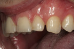 Figure 7  The patient’s left side dentition, close-up and retracted.
