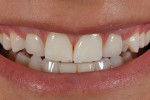 Fig 21. Patient’s smile with final restoration and bonding on the premolars closing diastemas (laboratory work by Toshiyuki
Fujiki, RDT).