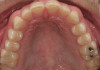 Figure 1  CLINICAL EXAMPLES Severe early childhood caries.