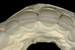 Figure 11  The facial incisal edge was marked with a red pencil, while a 0.3-mm lead pencil was used to mark a 0.5-mm line lingually, which indicated the need for a facial reduction.
