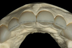 Figure 12  The 0.5-mm facial reduction was accomplished using a KOMET K6974 220 centered diamond disc bevel.