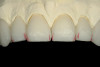 Figure 3  BLEACHING PROCEDURE  The path of insertion of the tray should be from the facial. Try in the tray with the patient before heating to ensure a proper path of insertion and full patient understanding of relaxing their lip