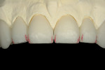 Figure 13  A red pencil was used to mark the incisal interproximal area to be troughed out with the KOMET K6974 220 centered diamond disc.