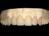 Figure 4  BLEACHING PROCEDURE After the softened tray is seated correctly, quickly apply finger pressure on the facial and lingual of the tray to adapt to the gingival areas, starting from the midline and proceeding distally.