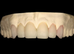 Figure 14  The finalized cut-back to the lithium-disilicate restorations.