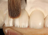 Figure 6  BLEACHING PROCEDURE When the tray has completely cooled in the mouth, disengage it from any brackets or wire extensions