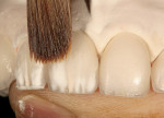 Figure 16  Using a brush, the internal powder effects were feathered apically.