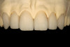Figure 10  BLEACHING PROCEDURE A thick 10% carbamide peroxide is applied sparingly in the groove area formed by the brackets.