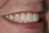 Figure 11  CLINICAL RESULTS This patient has used 10% CP for over 2 years in these trays. The trays were remade every 2 to 4 months, depending on the movement of the teeth.