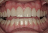 Figure 12  CLINICAL RESULTS fter removal of the brackets, there are no yellow spots or unbleached areas on the teeth, and no white spots from demineralization of the enamel.
