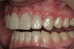 Figure 26  A left side view of the patient’s retracted postoperative smile.
