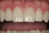 Figure 14  CLINICAL RESULTS Because the thermoplastic trays only come in one size, the most posterior teeth are often not included in the tray. However, the increase in pH in the mouth may still protect them from caries.
