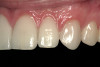Figure 1  CLINICAL EXAMPLES Classic presentation of the bruxism triad. Lateral wear pattern, generalized buccal tooth loss from erosion and abrasion, and history of sleep disruption.