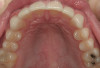 Figure 3  CLINICAL EXAMPLES In addition to the traditional sleep apnea risk factors (over 40 years old, male, overweight, >17 inch neck size), practitioners should add the tooth wear and erosion components of the bruxism triad.