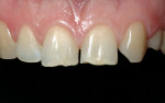 Figure 3  A look at the esthetic problems in more detail. Note the appearance of patient’s teeth and low value of color.