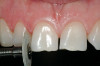 Figure 8  RESULTS OF THE TRIAD Young adult with signs and symptoms of the bruxism triad: Lateral tooth wear, erosive and abrasive damage to the teeth, and a history of moderate apnea.