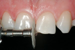 Figure 6  Minimally invasive preparation. Note that the angles are rounded and the little diastemas are opened between the lateral and central incisors, and between the central and canine on the other side.