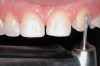 Figure 10  Recognizing Triad Patients, Extensive wear on stabilizing splint. It has been postulated that continued bruxism on splints is pathopneumonic for the bruxism triad.