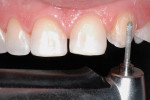 Figure 7  Minimally invasive preparation. Note that the angles are rounded and the little diastemas are opened between the lateral and central incisors, and between the central and canine on the other side.