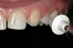Figure 8  Minimally invasive preparation. Note that the angles are rounded and the little diastemas are opened between the lateral and central incisors, and between the central and canine on the other side.