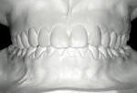 Figure 9: Diagnostic wax-up (mock-up) was done to check details about occlusion and spaces, helping the author determine exactly where to add ceramic and remove teeth.