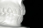 Figure 10  Diagnostic wax-up (mock-up) was done to check details about occlusion and spaces, helping the author determine exactly where to add ceramic and remove teeth.