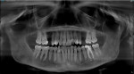 Preoperative panoramic radiograph showing the edentulous spaces at sites No. 4 and 13.