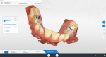 Design of screw-retained crowns.