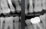 Postoperative radiograph showing fully seated screwretained implant crowns.