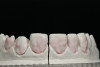 Figure 15  Early Signs and Treatment, Patient demonstrates wear on deciduous molars increasing the risk of bruxing as an adult. Another explanation may be the triad. Constricted dental arch, crowded lower anteriors, and a deep bite with a lifetime of airway-related issues. GERD history coupled with erosive wear on teeth.