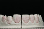 Figure 12  Provisional restoration was done through the wax-up, making it possible to get a mock-up that was fixed on the teeth, using provisional cement. Note the mock-up from the lateral view and frontal view. After studying the mock-up, the author