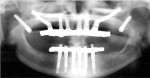 Panoramic radiograph depicts maxillary and mandibular implantretained restorations. Note that the pterygoid implants were left unloaded.