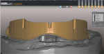 Design of CAD/CAM titanium bar in treatment planning software.