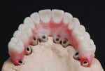 Final wax-up of maxillary prosthesis to be milled in zirconia. Note how the palatal orientation of the implants was best restored using a titanium bar with a cemented zirconia prosthesis. The entire restorative construction still provided a screw-retained prosthesis for retrievability.