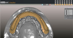 Occlusal view of CAD/CAM titanium bar. Note how the design of the anterior segment allows for maximum zirconia thickness in the anterior zone.