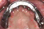 Intraoral view of final placement of CAD/CAM titanium bar, retained by four preexisting implants (white arrows) and four newly placed implants (red arrows).