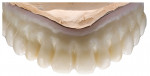 Zirconia prosthesis with initial cutback.