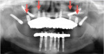 Panoramic radiograph illustrating the maxillary final prosthesis in place, retained by eight implants (Red arrows depict the four new implants.).