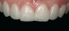 Figure 24 Advanced Triad, Many dentures worn at night demonstrate the same lateral wear facets indicative of the bruxism triad patient. A complete history of bruxism, sleep, and GERD should be obtained.