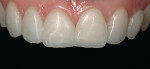 Figure 21  The clinical case using ceramic microlaminates is concluded. After 7 days, the gloss was removed using special rubber disks indicated for ceramic. Note the naturalness of the final appearance, the health of the gingival tissue, and the int