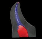 Figure 4  Micro-CT analysis of SAF instrumentation in the palatal root of the same maxillary molar with curved root canal morphology after treatment (blue). Note the long axis of the canal is respected along with a high ratio of canal wall treated. (