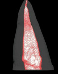 Figure 6  Micro-CT analysis of the same maxillary second bicuspid with extremely flat oval-shaped cross section, as seen on mesio–palatal view.