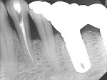 Figure 15  A periapical radiograph showing endodontic treatment performed using the SAF as the only instrument after establishing the glide path. The mandibular first bicuspid in this radiograph demonstrates the ability of the SAF to shape complex an