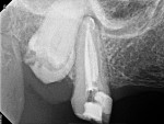 Figure 16  This radiograph demonstrates the preparation of a maxillary second molar, showing the ability of the SAF to respect the natural shape of the canals.