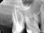 Figure 17  This re-treatment of a maxillary second molar shows the pretreatment radiograph and the postoperative result. Note that the SAF was able to maintain the delicate apical anatomy present in the apical third of the roots. (Cases treated by Dr
